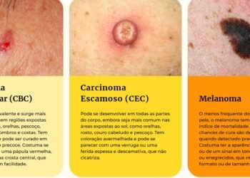 Campanha Dezembro Laranja reforça cuidados contra o câncer de pele